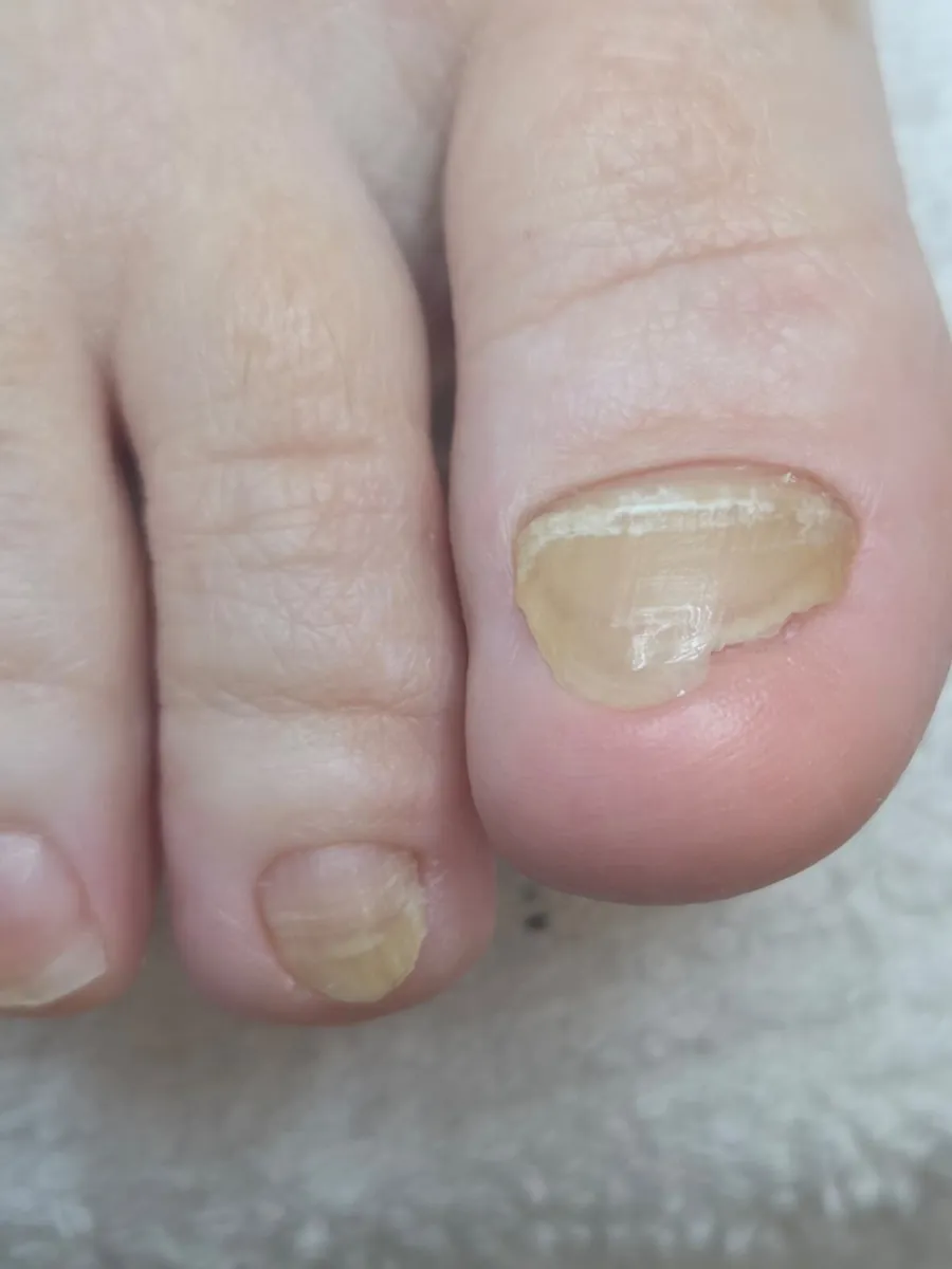 Nail correction before treatment