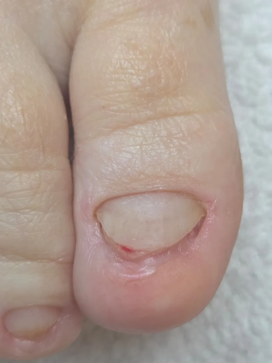 Nail correction after treatment
