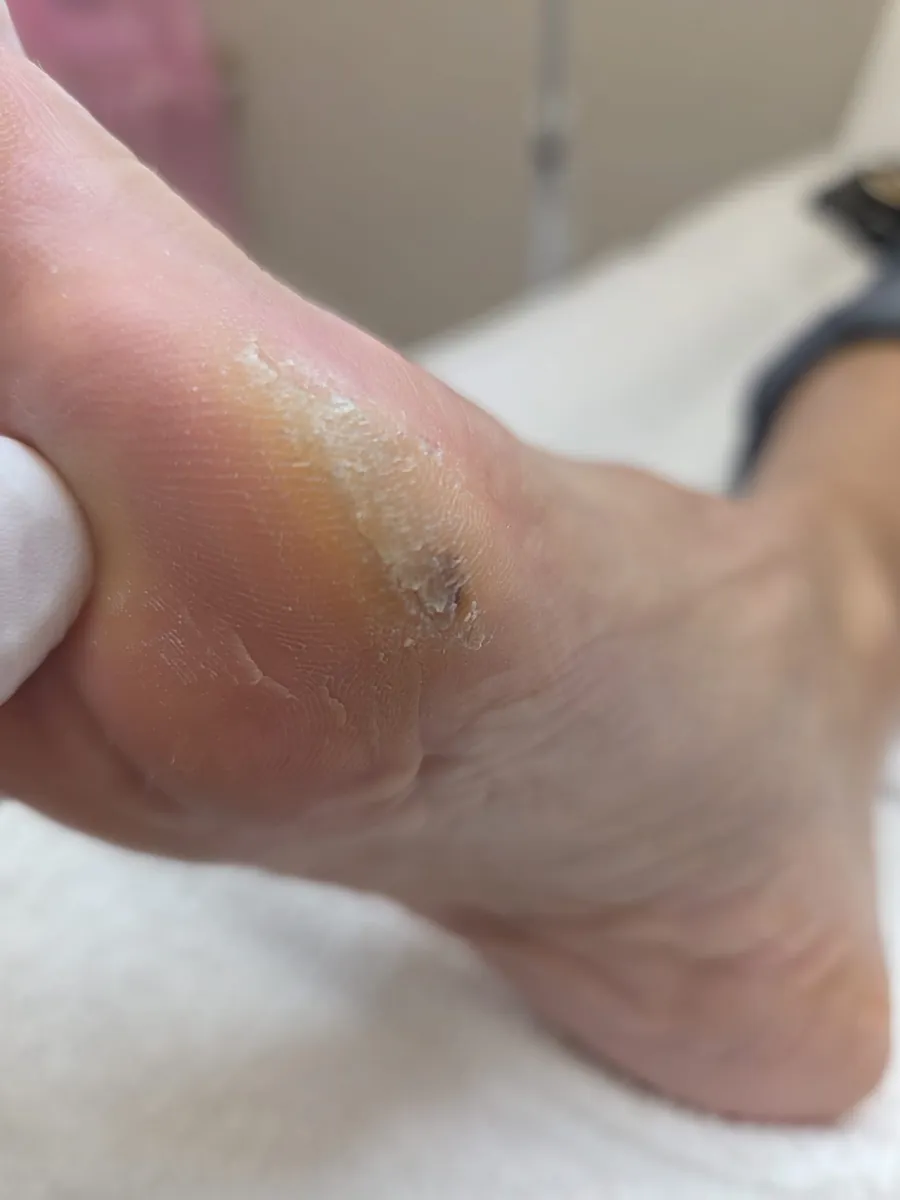 Hyperkeratosis before treatment