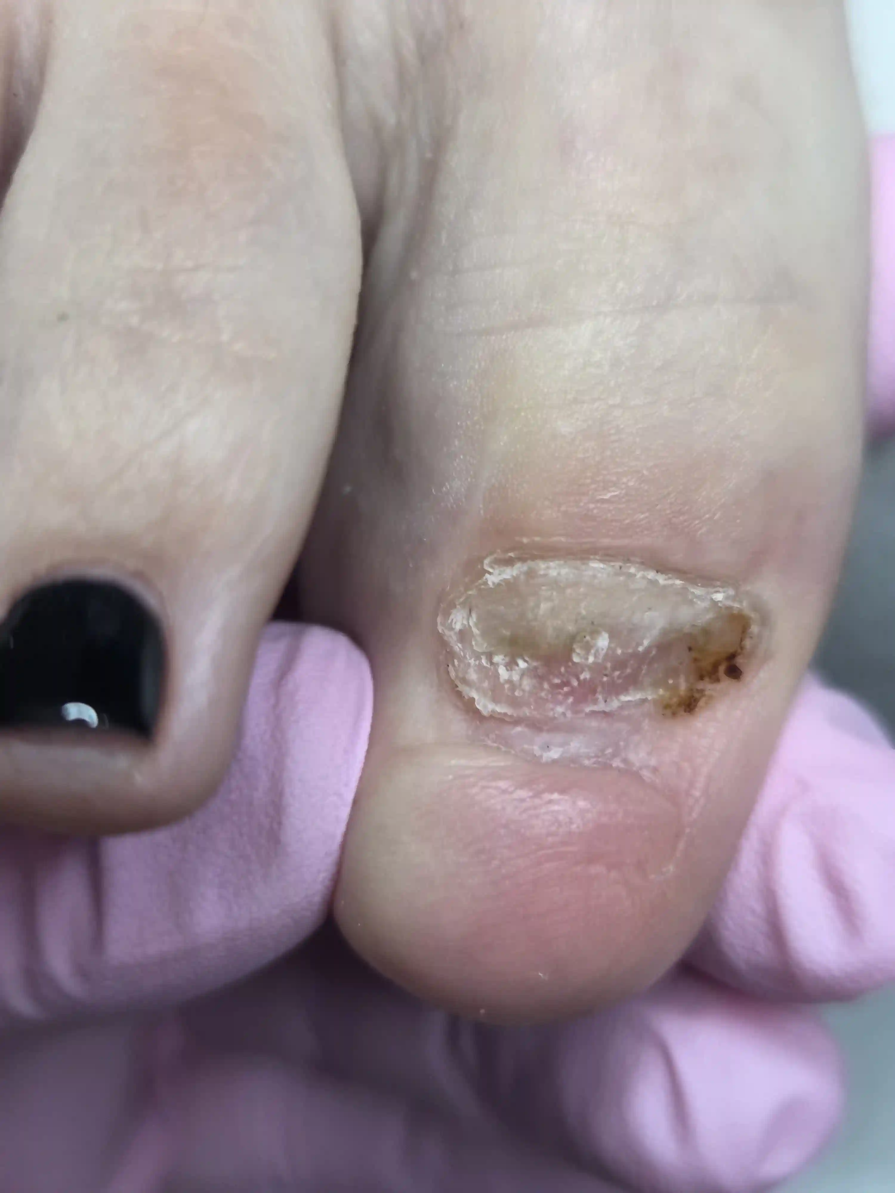 Feet before medical pedicure care