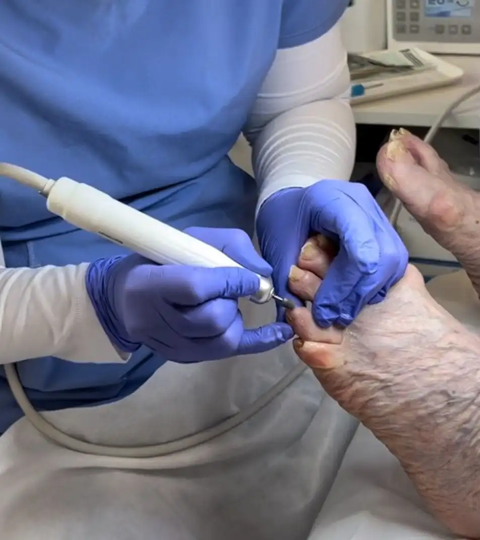 Toenail fungus care and nail restoration