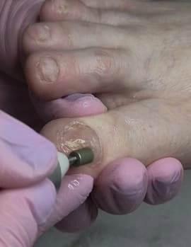 Individual care of thickened and damaged nails