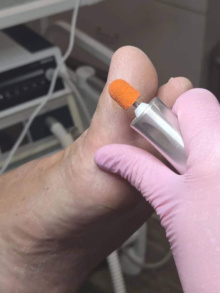 Hyperkeratosis and thick skin removal in Troy, MI