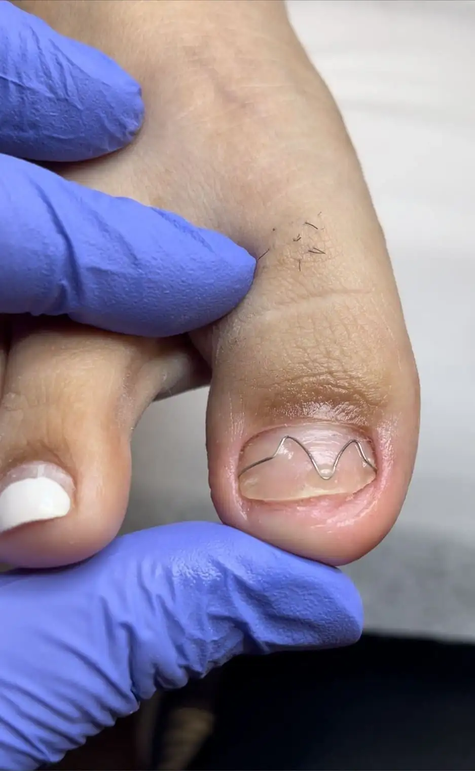 Toenail brace application for thickened nails